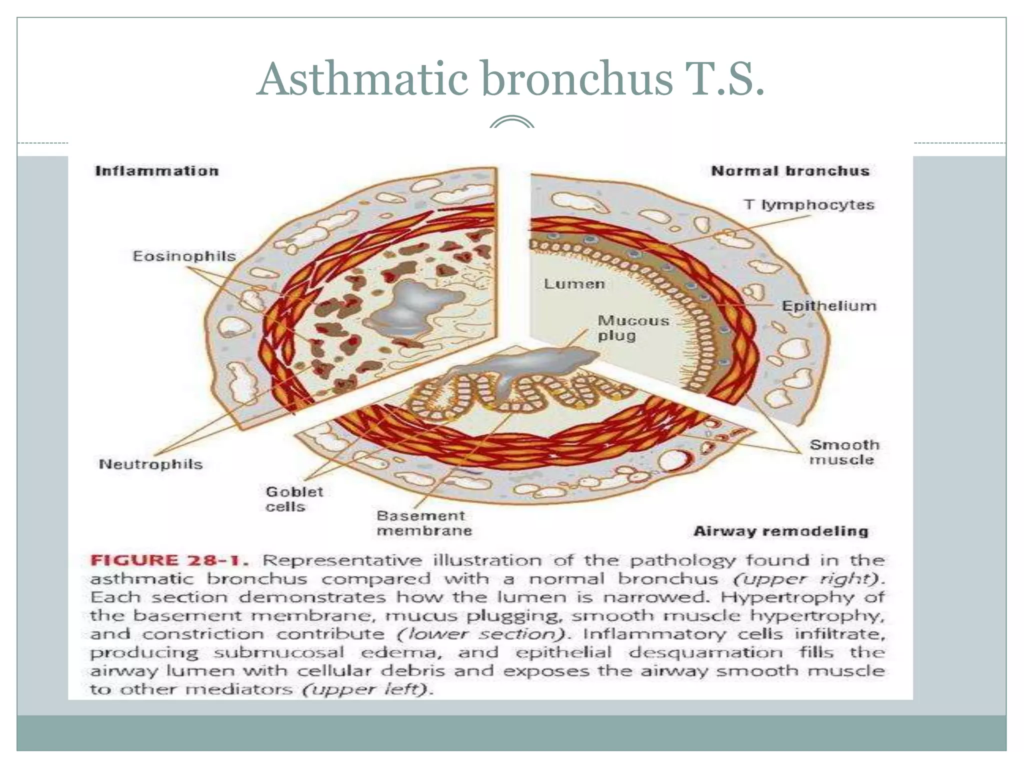 Asthmatic bronchus T.S.
 