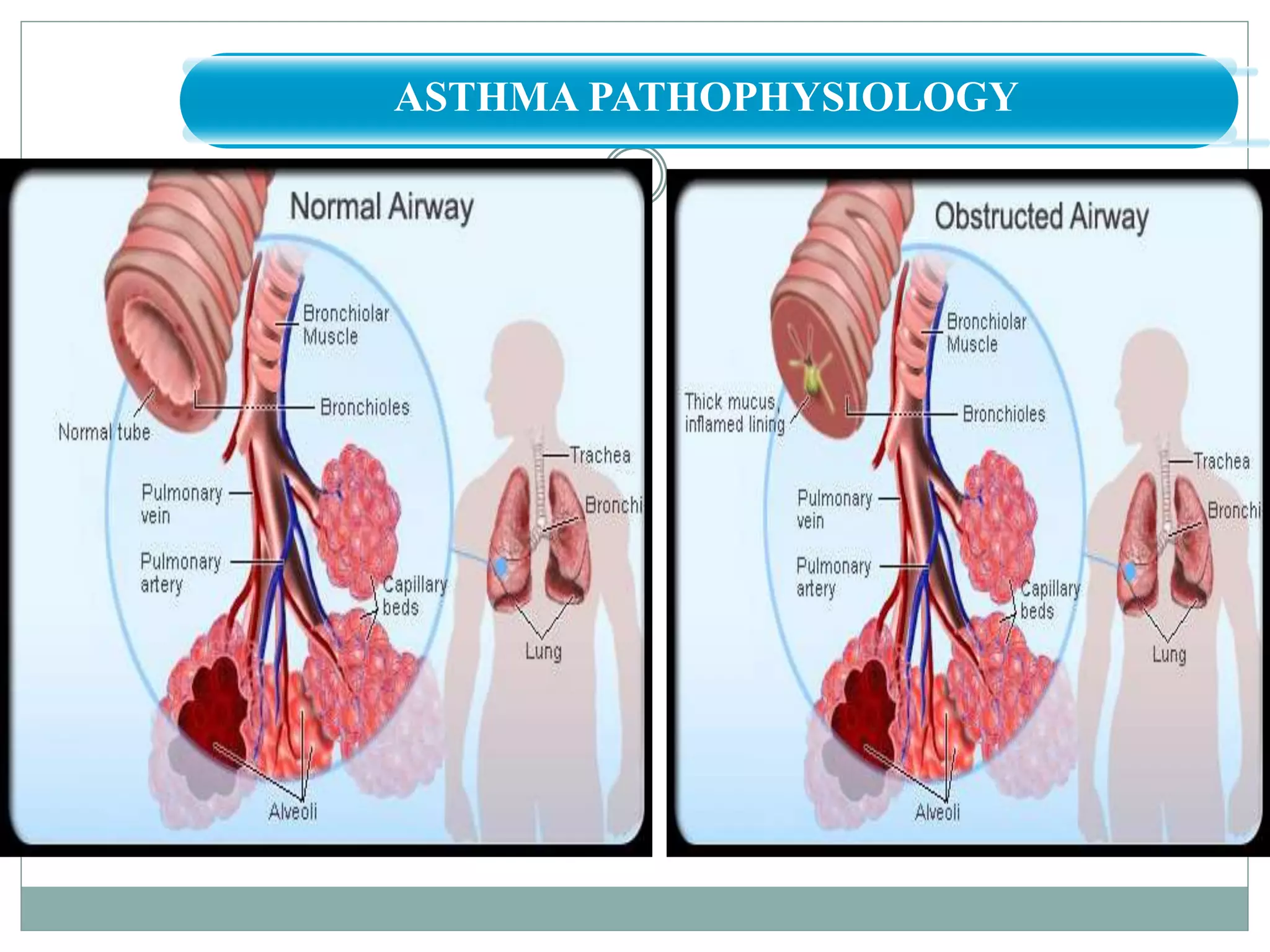 Hot TipASTHMA PATHOPHYSIOLOGY
 