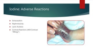 Iodine: Adverse Reactions
 Extravasation
 Nephrotoxicity
 Lactic Acidosis
 Contrast Reactions (AKA Contrast
“Allergy”)
 