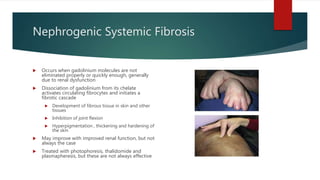 Nephrogenic Systemic Fibrosis
 Occurs when gadolinium molecules are not
eliminated properly or quickly enough, generally
due to renal dysfunction
 Dissociation of gadolinium from its chelate
activates circulating fibrocytes and initiates a
fibrotic cascade
 Development of fibrous tissue in skin and other
tissues
 Inhibition of joint flexion
 Hyperpigmentation , thickening and hardening of
the skin
 May improve with improved renal function, but not
always the case
 Treated with photophoresis, thalidomide and
plasmapheresis, but these are not always effective
 