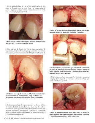 Publicación Científica Facultad de Odontología • UCR • Nº13 • 201150
1. Previa anestesia local al 2%, se hace sondeo a hueso para
medir la distancia entre la cresta ósea y el margen gingival
actual. Según el sondaje, existen 5 milímetros entre la cresta
ósea y el margen gingival. (Foto 1).
Foto 1. Se hace sondeo a hueso para medir la distancia entre
la cresta ósea y el margen gingival actual.
2. Con una hoja de bisturí No. 15c, se hace una incisión de
bisel interno, de 3mm de ancho y luego se realiza una incisión
intrasurcular para facilitar la remoción del tejido cortado. (Foto 2).
Foto 2. Con una hoja de bisturí No. 15c, se hace una incisión
de bisel interno, de 3mm de ancho, luego se efectúa una
incisión intrasurcular y se remueve el tejido excisionado.
3. Se levanta un colgajo de espesor parcial y se observa la línea
de fractura. Entre la línea de fractura y hueso hay de 1 a 2mm
de distancia, por lo que se decide hacer osteotomía de 1mm para
preservar el complejo dentogingival. (Foto 3 y 4). El propósito
es que el margen gingival quede a nivel de la línea de fractura o
a 0.5 milímetros subgingival.
Foto 3. Se levanta un colgajo de espesor parcial, y se deja el
periostio intacto en la porción vestibular y palatina.
Foto 4. Se observa la osteotomía que se realiza de 1 milímetro
de hueso. Si el margen de la restauración se coloca dentro del
surco gingival, debe mantenerse 3 milímetros de estructura
dentaria intacta sobre la cresta.
4. Una vez comprobado que existan los 3mm para respetar el
complejo dentogingival, se procede a suturar el colgajo con
sutura seda 4 ceros. (Foto 5).
Foto 5. Se coloca las suturas (seda negra 4´0s), en técnica de
ocho (pasando la aguja de epitelio a conectivo por vestibular
y por palatino de epitelio a tejido conectivo).
 