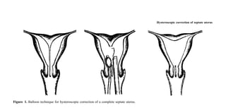 Hysteroscopic correction of septate uterus




Figure 1. Balloon technique for hysteroscopic correction of a complete septate uterus.



                         Table I. Pre-, intra- and postoperative data for six patients with complete uterine septum

                         Age                 Past history                         Time of                      Postoperative pregnancy
                         (years)                                                  surgery (min)

                         23                  Primary infertility;                 50                           Term pregnancy
                                             longitudinal vaginal septum                                       (Caesarean section)
                         28                  Recurrent abortion                   30                           Term pregnancy
                                             (three abortions)
                         30                  One abortion
                                             One preterm birth                    25                           –
                         23                  Primary infertility,
                                             longitudinal vaginal septum          25                           –
                         31                  Recurrent abortions                  30                           Term pregnancy
                                             (three abortions)
                         24                  Secondary infertility                20                           –
                                             (one abortion)



at 16 weeks gestation. Because of the prophylactic cervical                          uterus and septate vagina: report of a previously undescribed Mullerian¨
                                                                                     anomaly. Hum. Reprod., 11, 218–219.
suture, the advantage of this technique of spared cervical                         Daly, D.C., Tohan, N., Walters, C. et al. (1983) Hysteroscopic resection of
incision could not be clearly demonstrated. Although Vercellini                      the uterine septum in the presence of a septate cervix. Fertil. Steril., 39,
et al. (1989) could not show a positive effect of IUD insertion                      560–563.
and postoperative oestrogen administration, we used these two                      Ludmir, J., Samuels, P., Brooks, S. and Mennuti, M.T. (1990) Pregnancy
                                                                                     outcome of patients with uncorrected uterine anomalies managed in a high-
adjuvants with good results for the prevention of intrauterine                       risk obstetric setting. Obstet. Gynecol., 75, 906–910.
adhesions after septal dissection.                                                 Perino, A., Chianchiano, N., Simonaro, C. and Cittadini, E. (1995) Endoscopic
   The described balloon technique offers the possibility of                         management of a case of complete septate uterus. Hum. Reprod., 10,
                                                                                     2171–2173.
sparing the cervical septum during septum dissection in patients                   Rock, I. A., Murphy, A.A. and Cooper IV, W.H. (1987) Resectoscopic
with a complete uterine septum. The good clinical results of                         techniques for the lysis of a class V: complete uterine septum. Fertil. Steril.,
our procedure lead us to favour this technique. Because a                            48, 495–496.
complete uterine septum is such a rare uterine malformation,                       Salle, B., Sergeant, P., Gaucherand, P., et al. (1996) Transvaginal
                                                                                     hysterosonographic evaluation of septate uteri: a preliminary report. Hum.
a deﬁnitive recommendation can be given only after a random-                         Reprod., 11, 1004–1007.
ized multicentre study. In all cases of a uterine septum, an                       Vercellini, P., Fedele, L., Arcaini, L. et al. (1989) Value of intrauterine
indication for dissection must be critically proven because, even                    device insertion and estrogen administration after hysteroscopic metroplasty.
                                                                                     J. Reprod. Med., 34, 447–450.
without intervention, term pregnancies have been reported.                         Vercellini, P., Ragni, G., Trespidi, L. et al. (1994) A modiﬁed technique for
                                                                                     correction of the complete septate uterus. Acta Obstet. Gynecol. Scand.,
                                                                                     73, 425–428.
References
American Fertility Society (1988) The American Fertility Society                   Received on October 14, 1996; accepted on January 7, 1997
  classiﬁcations of adnexal adhesions, distal tubal occlusion, tubal occlusion
  secondary to tubal ligation, tubal pregnancies and intrauterine adhesions.
  Fertil. Steril., 49, 944–955.
Balasch, J., Moreno, E., Martinez-Roman, S. et al. (1996) Septate uterus with
  cervical duplication and longitudinal vaginal septum: a report of three new
  cases. Eur. J. Obstet. Gynecol. Reprod. Biol., 65, 241–243
Candiani, M., Busacca, M., Natale, A. and Sambruni, I. (1996) Bicervical

                                                                                                                                                                479
 