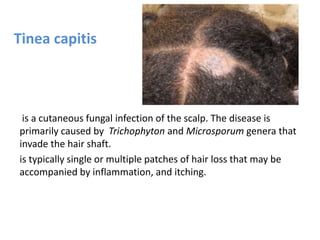 Tinea capitis
is a cutaneous fungal infection of the scalp. The disease is
primarily caused by Trichophyton and Microsporum genera that
invade the hair shaft.
is typically single or multiple patches of hair loss that may be
accompanied by inflammation, and itching.
 