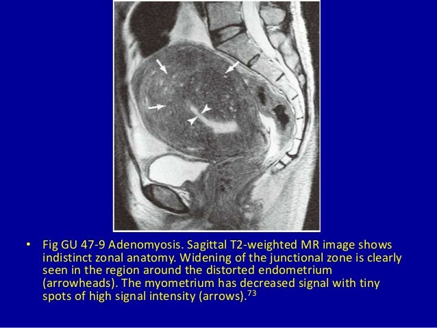 47 Diffusely Enlarged Uterus On Magnetic Resonance Imaging