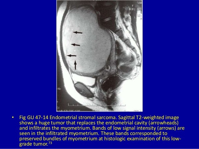 47 Diffusely Enlarged Uterus On Magnetic Resonance Imaging