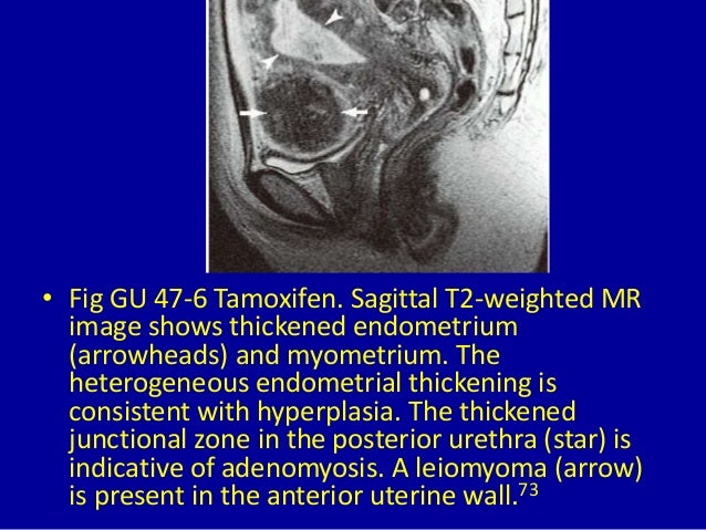 47 Diffusely Enlarged Uterus On Magnetic Resonance Imaging 47 Diffusely Enlarged Uterus On Magnetic Resonance Imaging