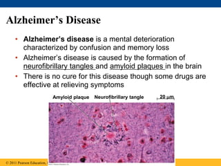 Alzheimer’s Disease
• Alzheimer’s disease is a mental deterioration
characterized by confusion and memory loss
• Alzheimer’s disease is caused by the formation of
neurofibrillary tangles and amyloid plaques in the brain
• There is no cure for this disease though some drugs are
effective at relieving symptoms
© 2011 Pearson Education, Inc.
Amyloid plaque Neurofibrillary tangle 20 m
 