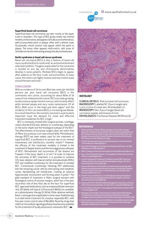 Treating Basal Cell Carcinoma | PDF
