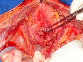 48   cirurgia citorredutora e quimioterapia intraperitoneal hipertérmica no tratamento da carcinomatose peritoneal