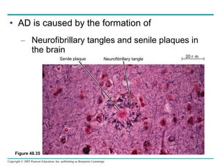 AD is caused by the formation of Neurofibrillary tangles and senile plaques in the brain Figure 48.35 Senile plaque Neurofibrillary tangle 20 m 