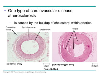 Copyright © 2005 Pearson Education, Inc. publishing as Benjamin Cummings
• One type of cardiovascular disease,
atherosclerosis
– Is caused by the buildup of cholesterol within arteries
Figure 42.18a, b
(a) Normal artery (b) Partly clogged artery
50 µm 250 µm
Smooth muscleConnective
tissue Endothelium Plaque
 