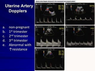 Uterine Artery
Dopplers
a. non-pregnant
b. 1st trimester
c. 2nd trimester
d. 3rd trimester
e. Abnormal with
↑resistance
 