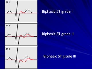 Biphasic ST grade I
Biphasic ST grade II
Biphasic ST grade III
 