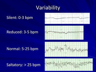 Variability
Silent: 0-3 bpm
Reduced: 3-5 bpm
Normal: 5-25 bpm
Saltatory: > 25 bpm
 