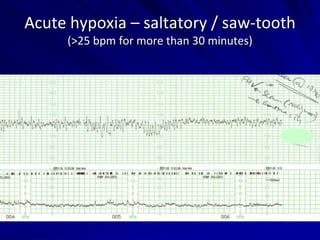 Acute hypoxia – saltatory / saw-tooth
(>25 bpm for more than 30 minutes)
 