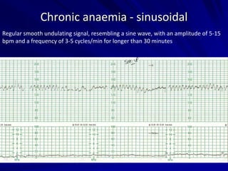 Chronic anaemia - sinusoidal
Regular smooth undulating signal, resembling a sine wave, with an amplitude of 5-15
bpm and a frequency of 3-5 cycles/min for longer than 30 minutes
 