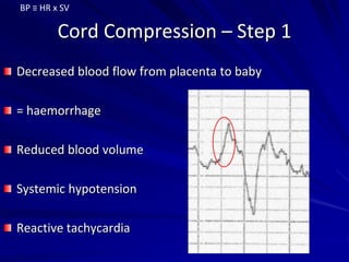 Cord Compression – Step 1
Decreased blood flow from placenta to baby
= haemorrhage
Reduced blood volume
Systemic hypotension
Reactive tachycardia
BP ≡ HR x SV
 