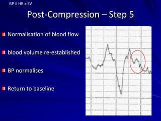 Post-Compression – Step 5
Normalisation of blood flow
blood volume re-established
BP normalises
Return to baseline
BP ≡ HR x SV
 
