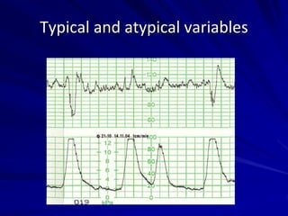 Typical and atypical variables
 