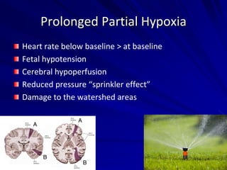 Prolonged Partial Hypoxia
Heart rate below baseline > at baseline
Fetal hypotension
Cerebral hypoperfusion
Reduced pressure “sprinkler effect”
Damage to the watershed areas
 