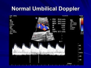 Normal Umbilical Doppler
 