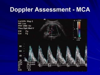 Doppler Assessment - MCA
 