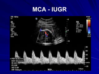 MCA - IUGR
 