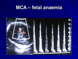 MCA – fetal anaemia
 