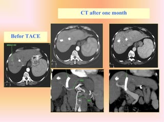 CT after one month
Befor TACE
 