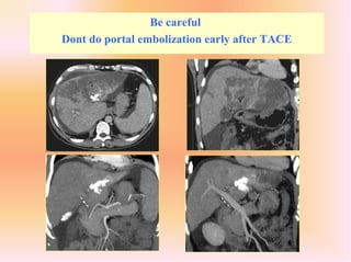 Be careful
Dont do portal embolization early after TACE
 