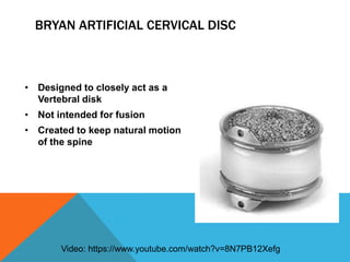 BRYAN ARTIFICIAL CERVICAL DISC
• Designed to closely act as a
Vertebral disk
• Not intended for fusion
• Created to keep natural motion
of the spine
Video: https://www.youtube.com/watch?v=8N7PB12Xefg
 