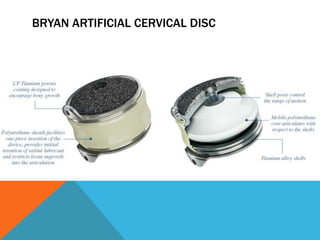 BRYAN ARTIFICIAL CERVICAL DISC
 