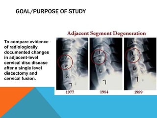 GOAL/PURPOSE OF STUDY
To compare evidence
of radiologically
documented changes
in adjacent-level
cervical disc disease
after a single level
discectomy and
cervical fusion.
 