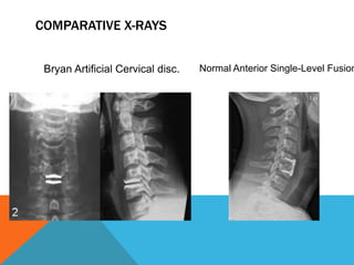 COMPARATIVE X-RAYS
Bryan Artificial Cervical disc. Normal Anterior Single-Level Fusion
 