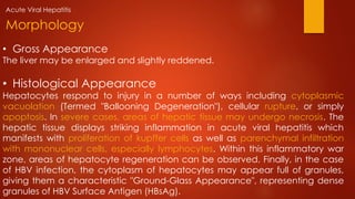 • Gross Appearance
The liver may be enlarged and slightly reddened.
• Histological Appearance
Hepatocytes respond to injury in a number of ways including cytoplasmic
vacuolation (Termed "Ballooning Degeneration"), cellular rupture, or simply
apoptosis. In severe cases, areas of hepatic tissue may undergo necrosis. The
hepatic tissue displays striking inflammation in acute viral hepatitis which
manifests with proliferation of kupffer cells as well as parenchymal infiltration
with mononuclear cells, especially lymphocytes. Within this inflammatory war
zone, areas of hepatocyte regeneration can be observed. Finally, in the case
of HBV infection, the cytoplasm of hepatocytes may appear full of granules,
giving them a characteristic "Ground-Glass Appearance", representing dense
granules of HBV Surface Antigen (HBsAg).
Morphology
Acute Viral Hepatitis
 