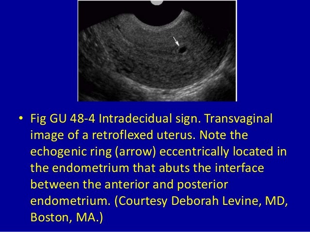 Uterus The Ring Sign Mentration Uterus The Ring Sign Mentration