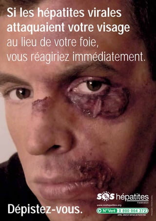 Dépistez-vous.

www.soshepatites.org

0 800 004 372

Photographie : Christian Sheibling

Si les hépatites virales
attaquaient votre visage
au lieu de votre foie,
vous réagiriez immédiatement.

 