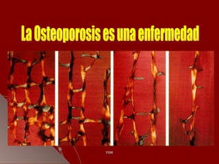 La Osteoporosis es una enfermedad 