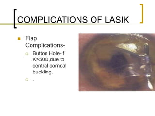 COMPLICATIONS OF LASIK
 Flap
Complications-
 Button Hole-If
K>50D,due to
central corneal
buckling.
 .
 