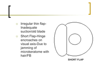 Irregular thin flap-
Inadequate
suction/old blade
 Short Flap-Hinge
encroaches on
visual axis-Due to
jamming of
microkeratome with
hair/FB
SHORT FLAP
 