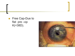  Free Cap-Due to
flat pre –op
K(<38D).
 