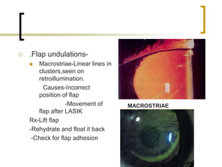  .Flap undulations-
 Macrostriae-Linear lines in
clusters,seen on
retroillumination.
Causes-Incorrect
position of flap
-Movement of
flap after LASIK
Rx-Lift flap
-Rehydrate and float it back
-Check for flap adhesion
MACROSTRIAE
 
