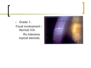  Grade 1-
Focal involvement -
Normal V/A.
Rx Intensive
topical steroids.
 