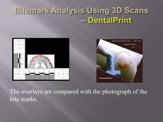 The overlays are compared with the photograph of the
bite marks.
 