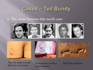    The most famous bite mark case




The bite mark was on   Transparent overlays   Wax bite exemplar
the body of a victim   superimposed
 