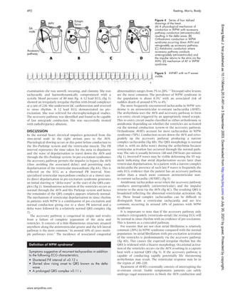 examination she was unwell, sweating, and clammy. She was
tachycardic and haemodynamically compromised with a
systolic blood pressure of 80 mm Hg. A 12 lead ECG (fig 3)
showed an irregularly irregular rhythm with broad complexes
at a rate of 220. She underwent DC cardioversion and reverted
to sinus rhythm. A 12 lead ECG demonstrated no pre-
excitation. She was referred for electrophysiological studies.
The accessory pathway was identified and found to be capable
of fast antegrade conduction. She was successfully treated
with radiofrequency ablation.
DISCUSSION
In the normal heart electrical impulses generated from the
sino-atrial node in the right atrium pass to the AVN.
Physiological slowing occurs at this point before conduction to
the His-Purkinje system and the ventricular muscle. The PR
interval represents the time taken for the atria to depolarise
and the wave of depolarisation to travel down the AVN and
through the His-Purkinje system. In pre-excitation syndromes
the accessory pathway permits the impulse to bypass the AVN
(thus avoiding the associated delay) and permitting early
depolarisation of the ventricular myocardium (fig 4A). This is
reflected on the ECG as a shortened PR interval. Non-
specialised ventricular myocardium conducts at a slower rate.
Its direct depolarisation in pre-excitation syndrome generates
an initial slurring or “delta wave” at the start of the QRS com-
plex (fig 2). Simultaneous activation of the ventricles occurs as
normal through the AVN and His Purkinje system and hence
the remainder of the QRS complex appears relatively normal.
The mechanism of ventricular depolarisation in sinus rhythm
in patients with WPW is a combination of pre-excitation and
normal conduction giving rise to a short PR interval and a
delta wave followed by a relatively normal QRS complex (fig
2).
The accessory pathway is congenital in origin and results
from a failure of complete separation of the atria and
ventricles. It consists of a thin filamentous structure situated
anywhere along the atrioventricular groove and the left lateral
pathway is the most common.4
In around 10% of cases multi-
ple pathways exist.5
The incidence of associated congenital
abnormalities ranges from 7% to 20%.3 6
Tricuspid valve lesions
are the most common. The prevalence of WPW syndrome in
the population is about 0.3%3
with an associated risk of
sudden death of around 0.5% to 4%.7
The most frequently encountered tachycardia in WPW syn-
drome is an atrioventricular re-entrant tachycardia (AVRT).
The arrhythmia uses the AVN and accessory pathway to form
a re-entry circuit triggered by an appropriately timed ectopic.
This re-entry circuit maybe classified as either orthodromic or
antidromic depending on whether the ventricles are activated
via the normal conduction system or the accessory pathway.
Orthodromic AVRTs account for most tachycardias in WPW
syndrome (70%). Conduction occurs down the AVN and retro-
gradely up the accessory pathway producing a narrow
complex tachycardia (fig 4B). The QRS morphology is normal
(that is, with no delta wave) during the arrhythmia because
ventricular activation has occurred through the normal path-
way. The rate is usually between 140 and 250 beats per minute
(fig 1). Inverted P waves may be visible deforming the ST seg-
ment indicating that atrial depolarisation occurs later than
ventricular depolarisation. In a patient with a narrow complex
tachycardia the presence of such late P waves is frequently the
only ECG evidence that the patient has an accessory pathway
rather than a much more common atrioventricular non-
re-entrant tachycardia (AVNRT) (fig 5).
Antidromic tachycardias occur when the accessory pathway
conducts anterogradely (atrioventricular) and the impulse
returns to the atria via the AVN (fig 4C). The resulting QRS is
broadened reflecting the abnormal ventricular activation (fig
6). These broad complex tachycardias can be difficult to
distinguish from a ventricular tachycardia and are less
common, occurring in around 10% of patients with WPW
syndrome.
It is important to note that if the accessory pathway only
conducts retrogradely (ventriculo-atrial) the resting ECG will
be normal in sinus rhythm with no evidence of pre-excitation.
This is known as a concealed pathway.
For reasons that are not clear atrial fibrillation is relatively
common (20%) in WPW syndrome compared with the normal
population. In atrial fibrillation with pre-excitation activation
of the ventricles is predominantly via the accessory pathway
(fig 4D). This causes the expected irregular rhythm but the
QRS is widened with a bizarre morphology. Occasional activa-
tion of the ventricles occurs via the AVN resulting in a capture
beat with a normal QRS (fig 3). If the accessory pathway is
capable of conducting rapidly potentially life threatening
arrhythmias may result. The ventricular response may be in
the region of 180–220.
Treatment of AVRTs essentially consists of interrupting the
re-entrant circuit. Stable symptomatic patients can safely
undergo vagal manoeuvres to block the AVN conduction and
Figure 4 Series of four stylised
drawings of the heart.
(A) A physiological mechanism of
conduction in WPW with accessory
pathway conduction (atrioventricular)
resulting in the delta wave. (B)
Orthodromic conduction in WPW
syndrome occurring down AVN and
retrogradely up accessory pathway.
(C) Antidromic conduction where
accessory pathway conducts
anterogradely (atrioventricular) and
the impulse returns to the atria via the
AVN. (D) mechanism of AF in WPW
syndrome.
Definition of WPW syndrome3
Symptoms suggestive of recurrent tachycardias in addition
to the following ECG characteristics;
• Shortened P-R interval of <0.12 s
• Slurred slow rising onset to QRS known as the delta
wave
• A prolonged QRS complex >0.11 s
Figure 5 AVNRT with no P waves
visible.
492 Keating, Morris, Brady
www.emjonline.com
on
July
30,
2021
by
guest.
Protected
by
copyright.
http://emj.bmj.com/
Emerg
Med
J:
first
published
as
10.1136/emj.20.5.491
on
3
September
2003.
Downloaded
from
 