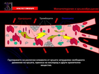 Victoria Bells
       MAGNET THER Y
                  AP                   Магнитотерапия и кръвообръщение


        Eритроцити        Тромбоцити         Левкоцити




Групирането на различни елементи от кръвта затруднява свободното
   движение на кръвта, преноса на кислород и други хранителни
                           вещества.
 