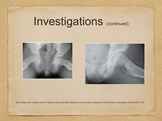 Investigations (continued)
• Frog Leg
NB. Straight line through centre of femoral neck proximally should be at the centre of epiphysis. If line anterior in epiphysis, likely SUFE. (RT)
 