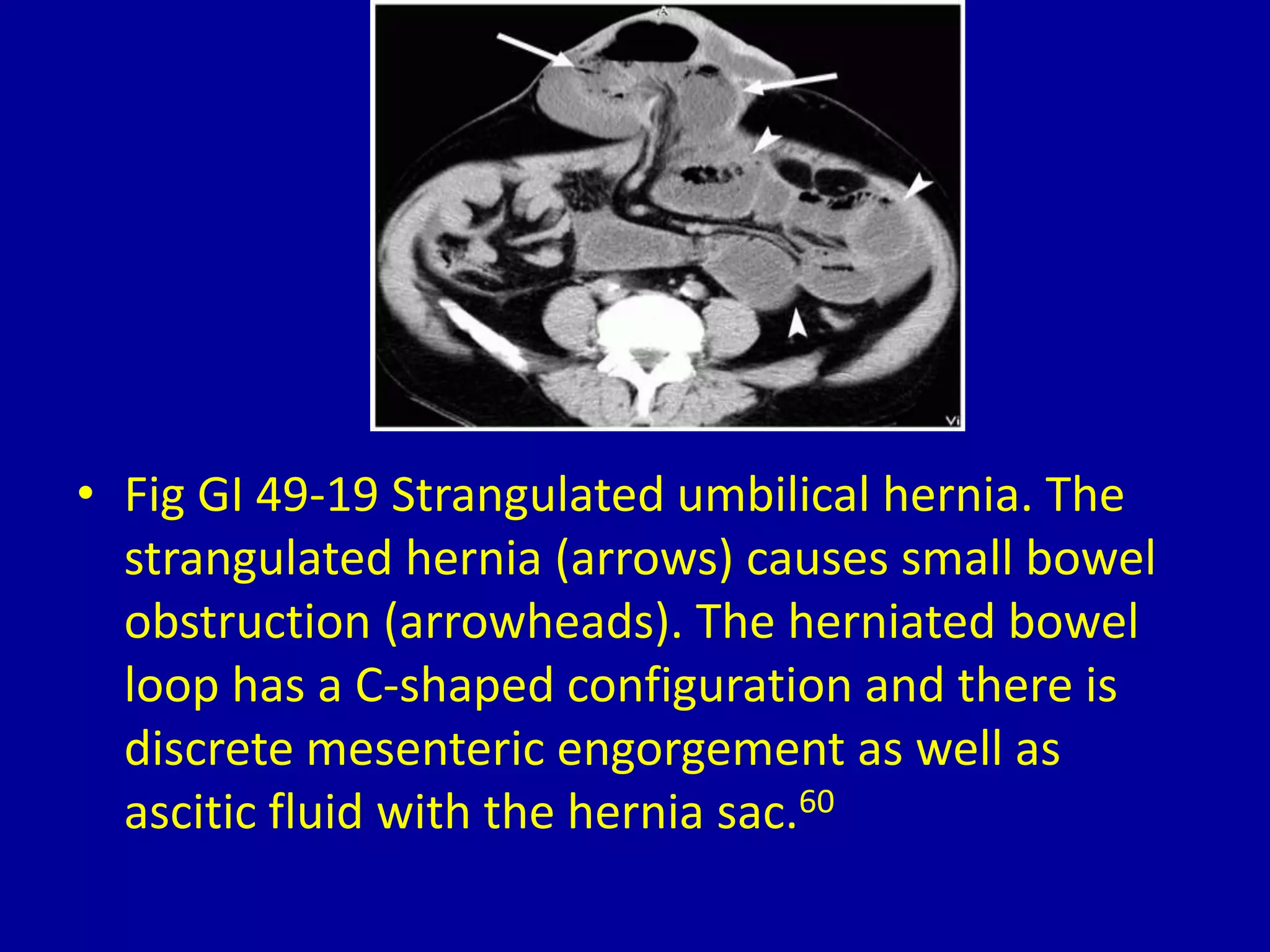 49-abdominal-hernias-pptx