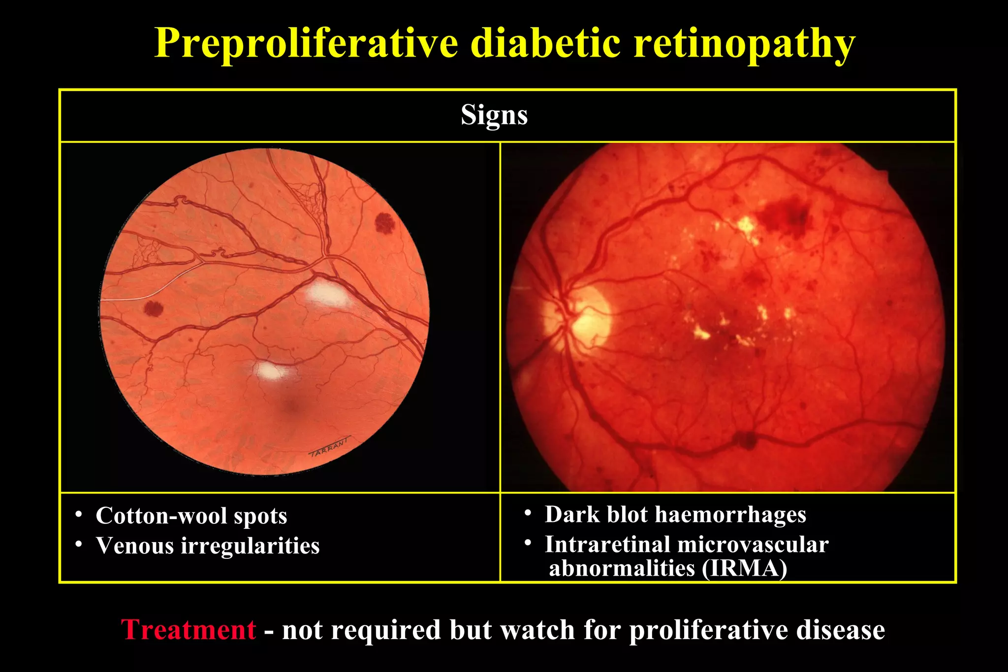 Preproliferative diabetic retinopathy
Treatment - not required but watch for proliferative disease
• Cotton-wool spots
• Venous irregularities
• Dark blot haemorrhages
• Intraretinal microvascular
abnormalities (IRMA)
Signs
 
